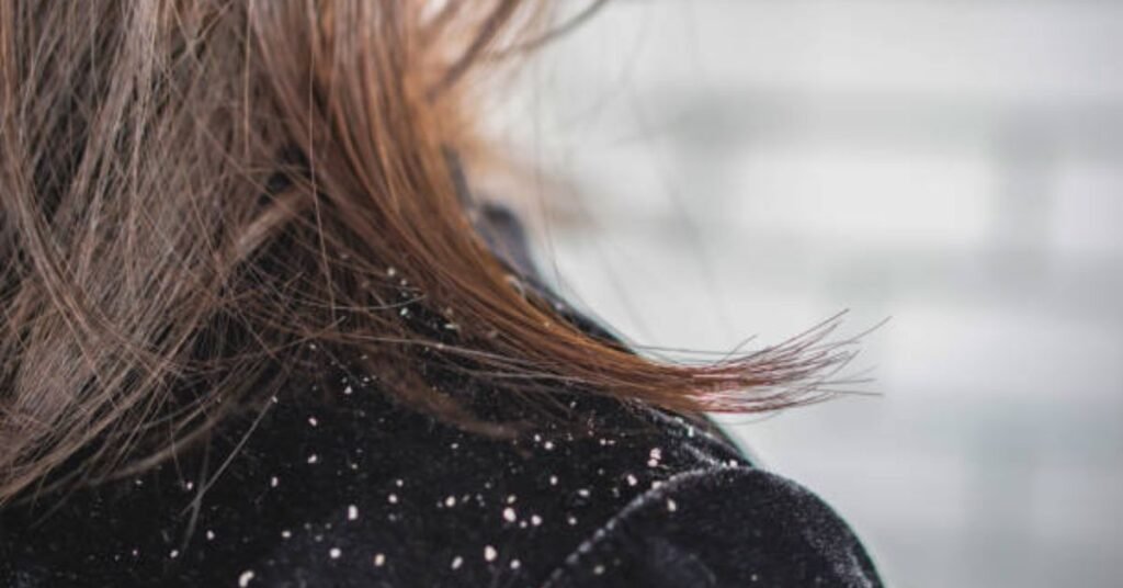 Home made remedy for dandruff removal